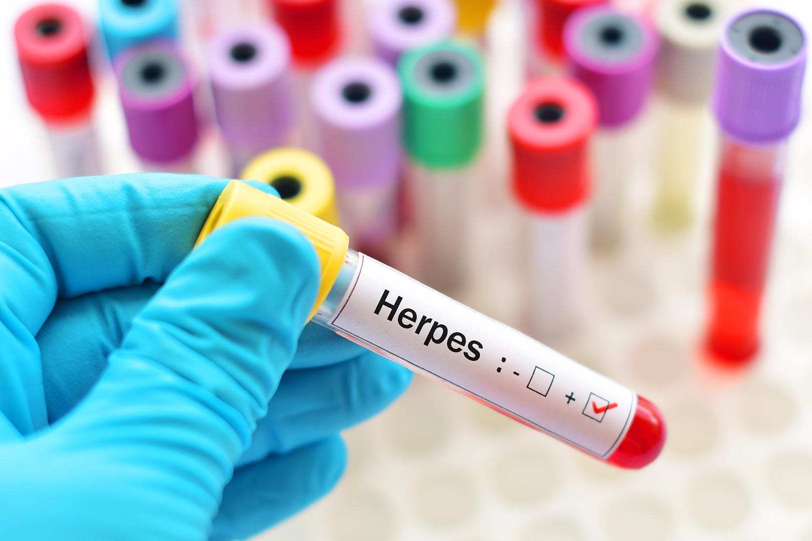Mengenali Gejala dan Obat Herpes Alami